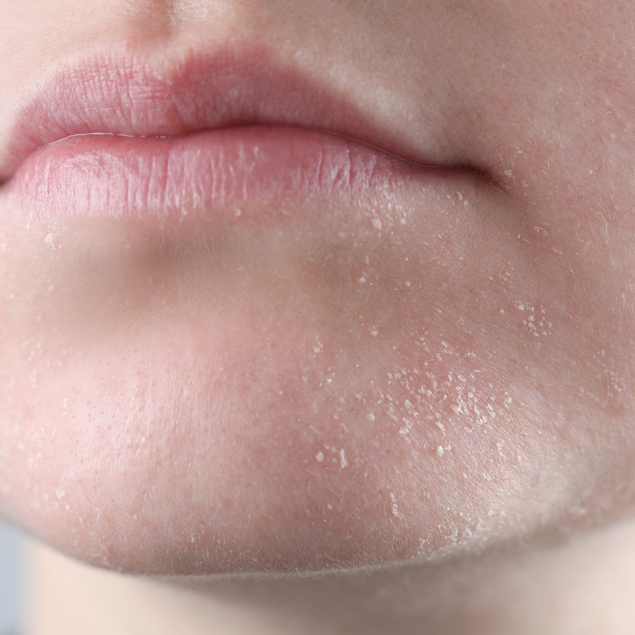 Welche Seife ist gut bei Neurodermitis oder Psoriasis?